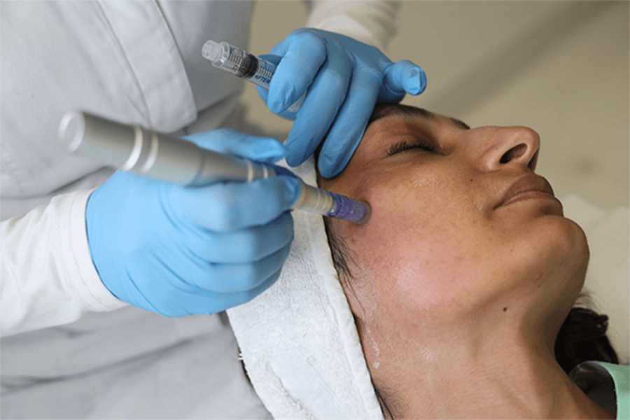 Fractional RF Micro Needling in Abu Dhabi