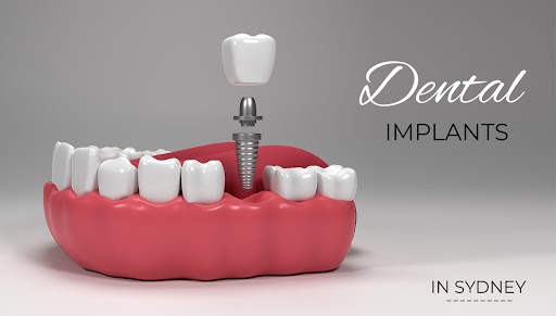 dental implants in chatswood sydney