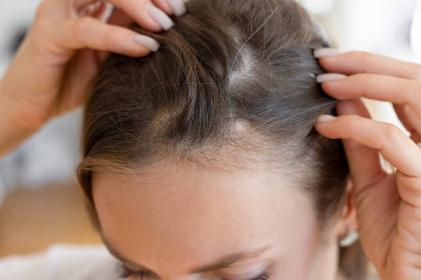 Hair Transplant in Riyadh
