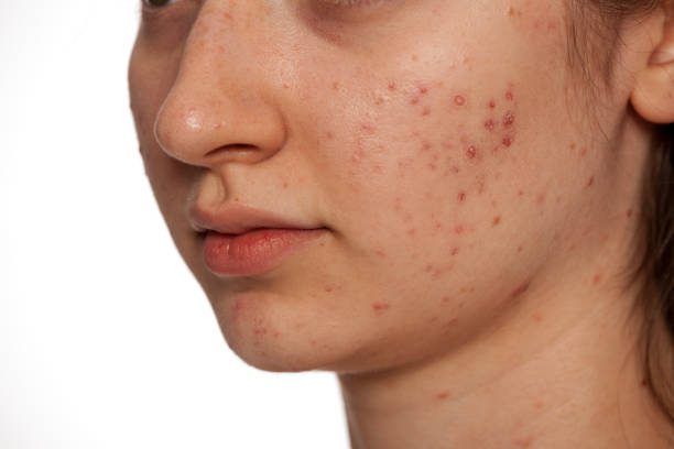 Can Acne Treatment Improve Uneven Skin Texture