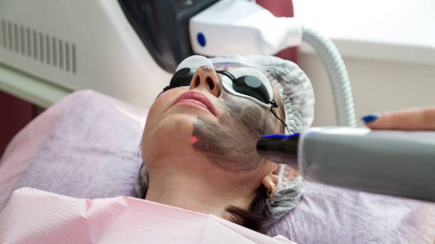 Can Laser Carbon Peel Reduce Acne Marks Naturally
