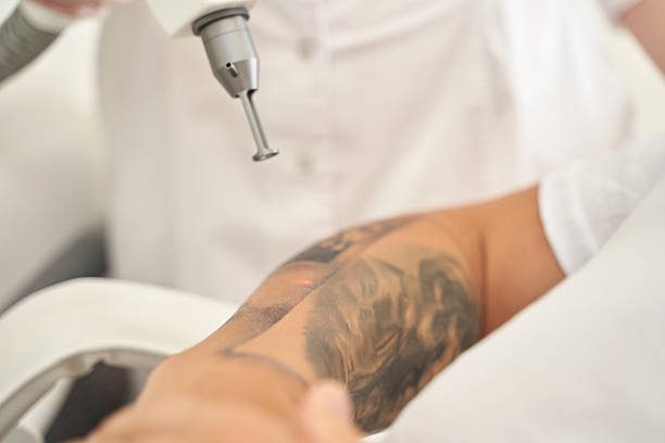 Can Laser Tattoo Removal Restore Clearer Skin