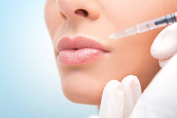 Can Lip Fillers Injection Provide Long-Lasting Lip Volume