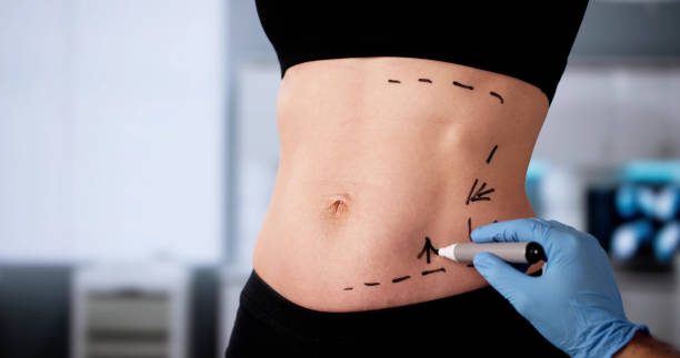 Can Tummy Tuck Improve Clothing Fit and Comfort