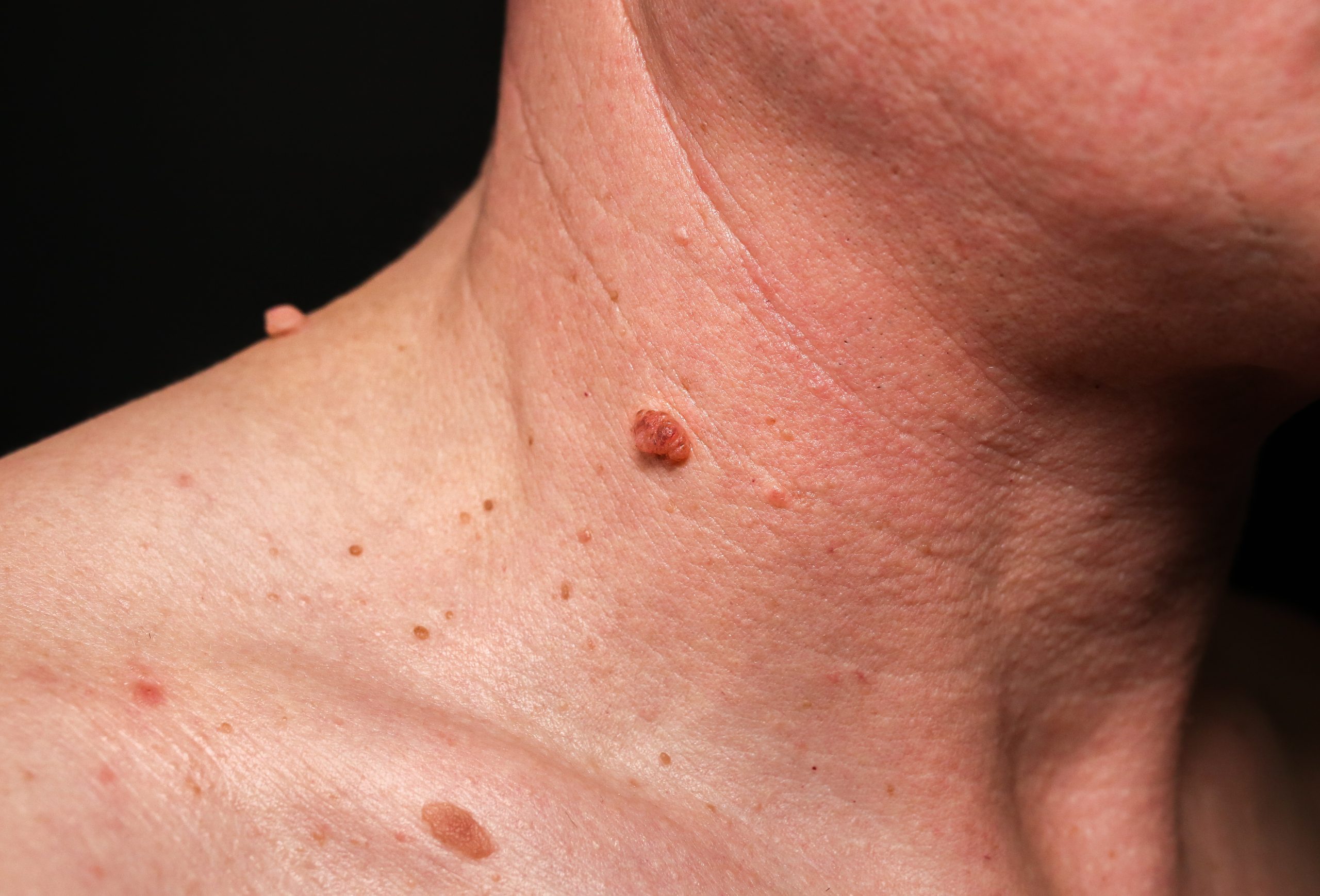 Skin Tag Removal in Abu Dhabi