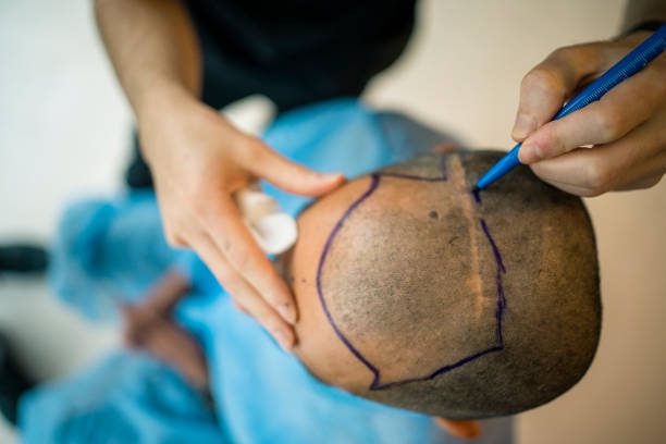 Is FUE Hair Transplant the Best Hair Treatment
