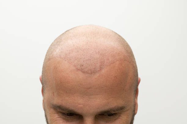 Is SMP Treatment a Fast Fix for Hairline Gaps