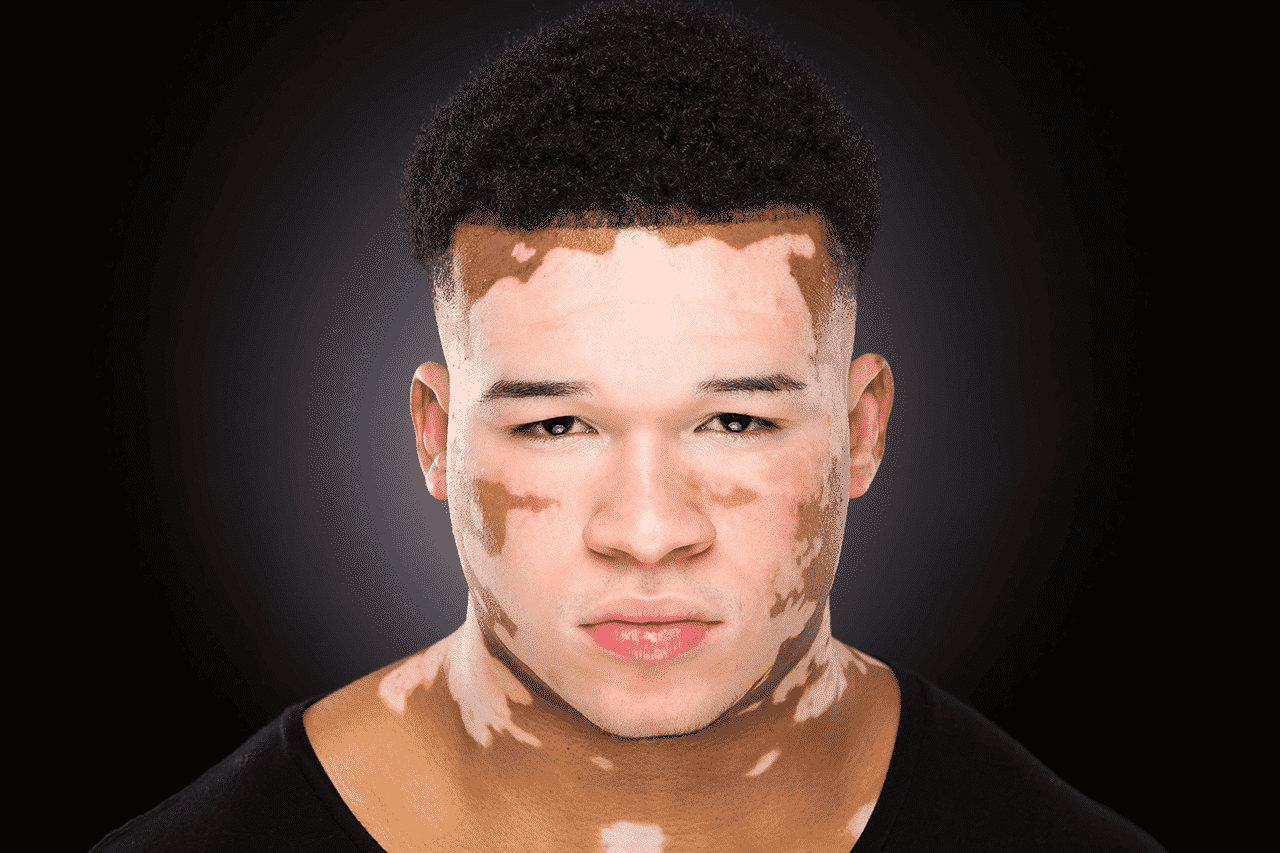 Vitiligo treatment in Abu Dhabi