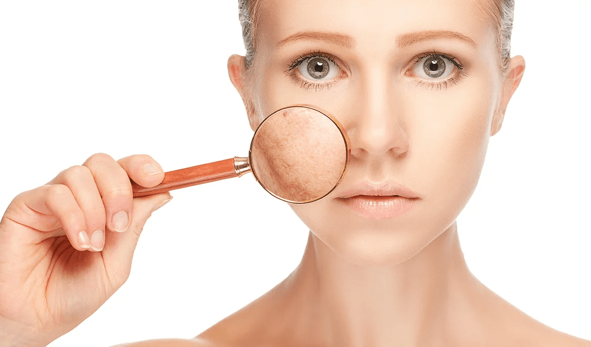 Laser Acne Scar treatment in Abu Dhabi
